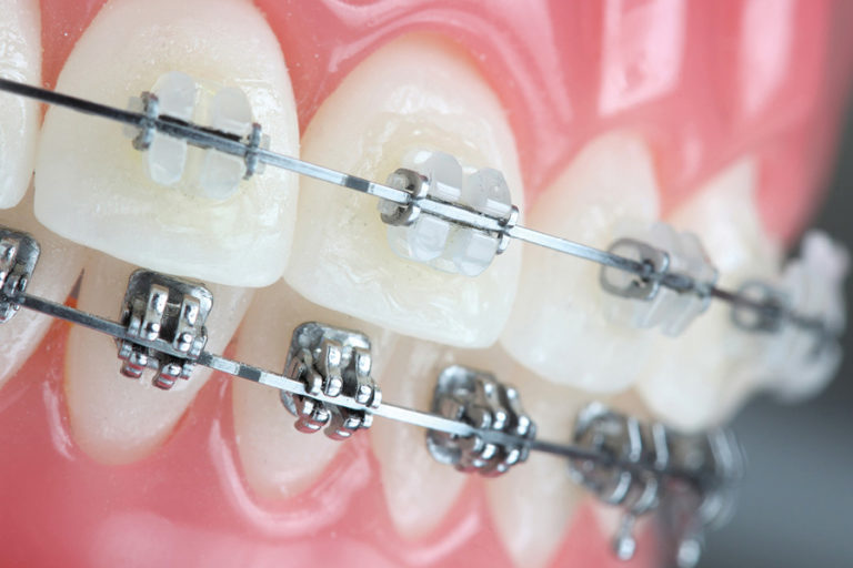dental claim for orthodontic treatment
